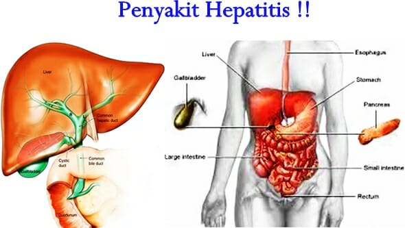penyakit hepatitis